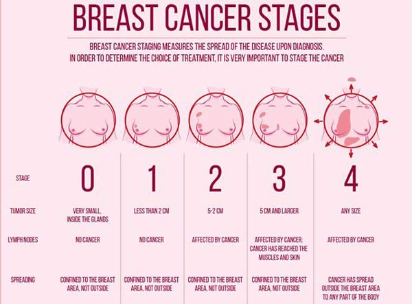 Breast Cancer Stages