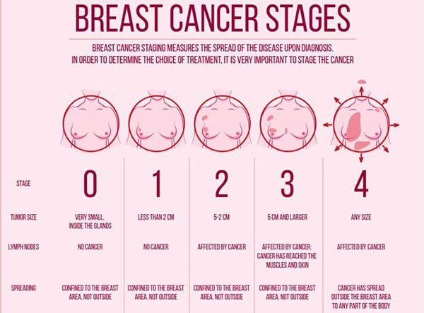 Stage 2 Breast Cancer Treatment Timeline Survival Rate