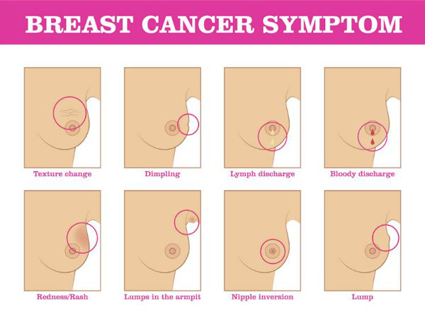 women cancer Symptoms in breast of