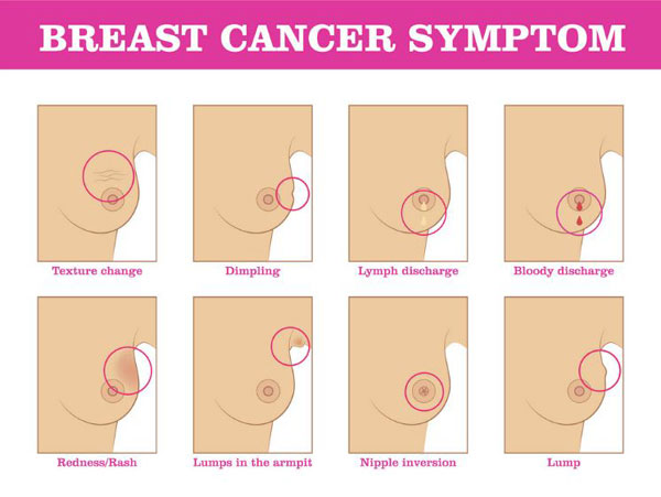 Symptoms of Breast Cancer