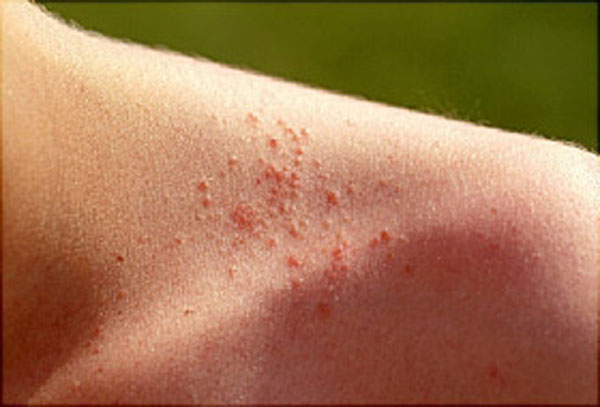 common-summer-diseases-and-ways-to-prevent-them