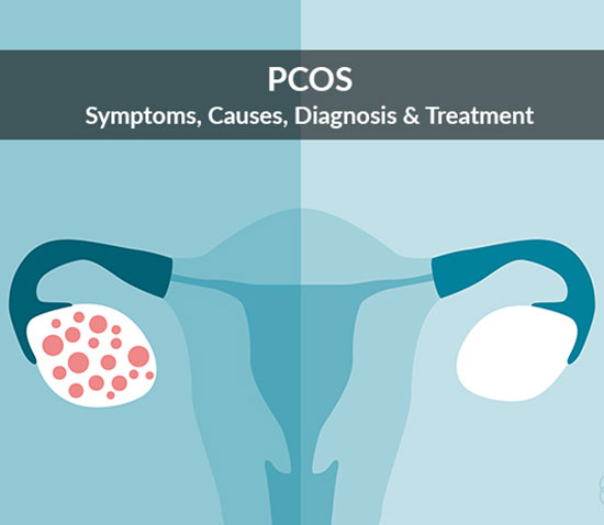 Polycystic ovary syndrome