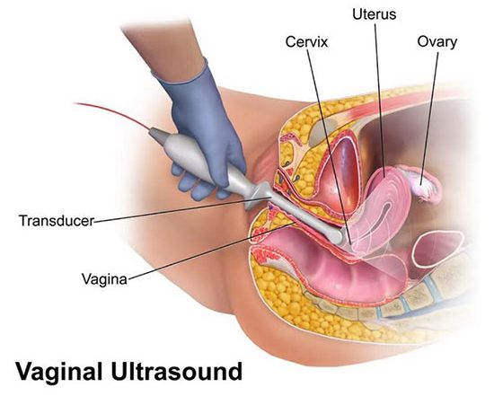 Vaginal Ultrasound