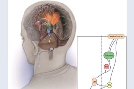 Cleveland Clinic Study Reveals Promising Results of Deep Brain Stimulation for Stroke Patients
