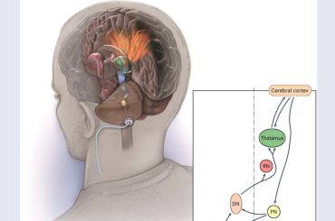 Cleveland Clinic Study Reveals Promising Results of Deep Brain Stimulation for Stroke Patients
