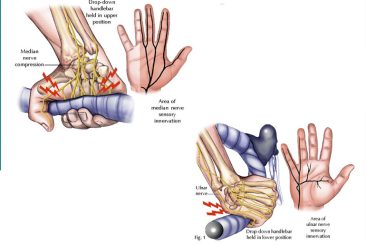 Pins and Needles or Numbness