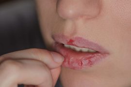 Unveiling Dermatillomania: Recognizing the Signs You Should Watch Out For