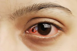 5 Symptoms of Eye Cancer and Ayurvedic Approaches to Prevention