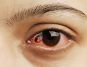 5 Symptoms of Eye Cancer and Ayurvedic Approaches to Prevention