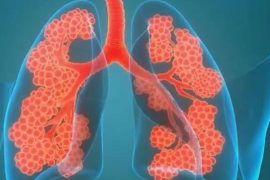Study: Post-COVID Lung Damage Worse in Indians - Strategies to Enhance Lung Function for Recovery