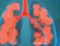Study: Post-COVID Lung Damage Worse in Indians - Strategies to Enhance Lung Function for Recovery