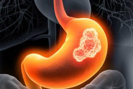 Unveiling Stomach Cancer: Comprehensive Guide to Causes, Symptoms, Treatment and Prevention Tips