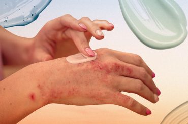 Exploring the Potential Impact of Weight Loss on Psoriasis Treatment