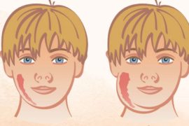 Mumps: From Symptoms to Prevention - Everything You Need to Know