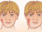Mumps: From Symptoms to Prevention - Everything You Need to Know