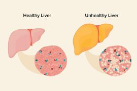Young Adults Face Fatty Liver Surge: Lifestyle Tweaks Offer Reversal Hope