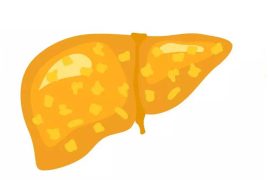 Fatty Liver in Diabetics & Obesity: Causes, Complications, Treatment, Prevention