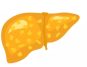 Fatty Liver in Diabetics & Obesity: Causes, Complications, Treatment, Prevention