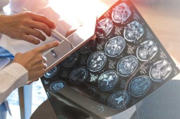 Doctor Shares Key Dietary Tips to Lower Multiple Sclerosis Risk