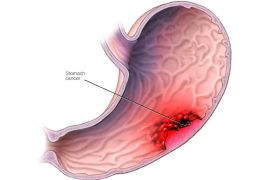 Stomach Cancer: Key Symptoms, Risk Factors, and Treatment Options to Watch Out For