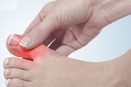 High Uric Acid Levels? No Need to Panic—Effective Home Remedies to Try