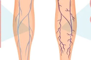 Struggling with Varicose Veins? Try These 5 Asanas to Alleviate Pain!