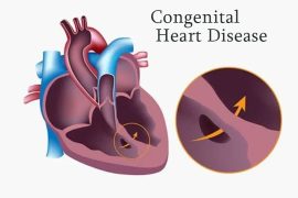 Congenital Heart Disease