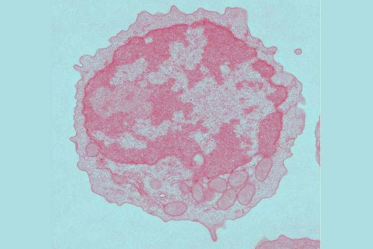 Aging impairs metabolism, which lowers CAR-T cell efficiency, study shows