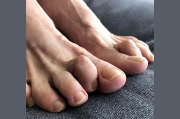 The Top 8 Unknown Solutions for Toe Issues That Podiatrists Suggest to reduce Pain