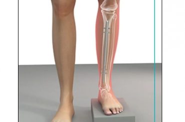 Surgeon warns that skipping leg day could prevent a heart attack