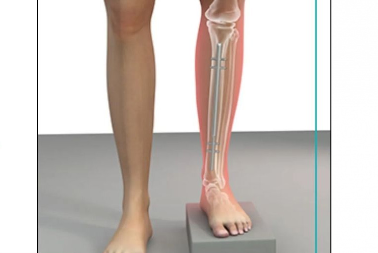 Surgeon warns that skipping leg day could prevent a heart attack