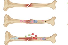 CALCEED® Unleashes New Power to Accelerate Bone Healing
