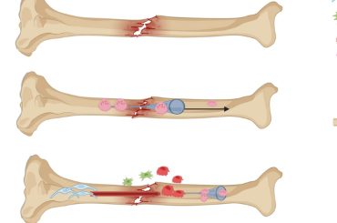 CALCEED® Unleashes New Power to Accelerate Bone Healing