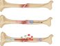 CALCEED® Unleashes New Power to Accelerate Bone Healing