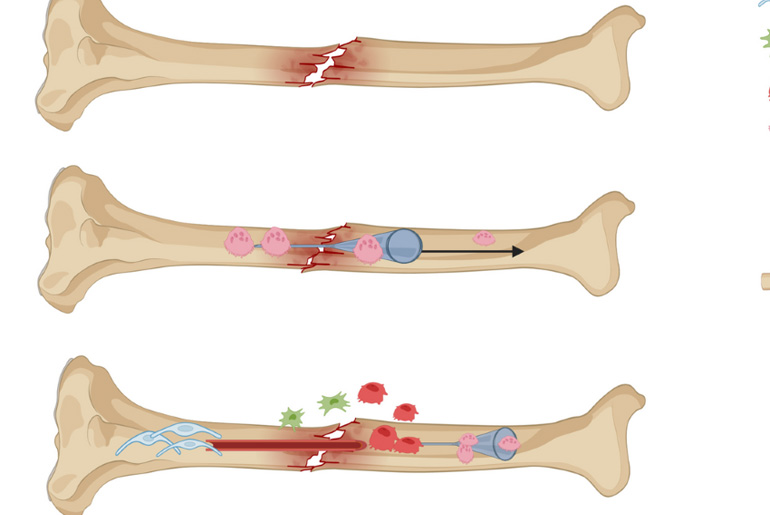 CALCEED® Unleashes New Power to Accelerate Bone Healing CALCEED® Unleashes New Power to Accelerate Bone Healing