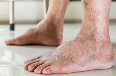 Peripheral Artery Disease