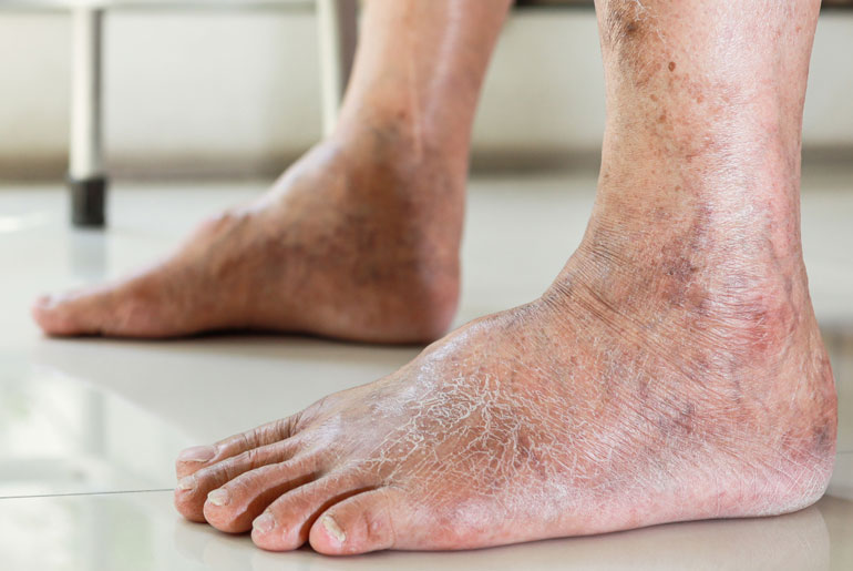 Peripheral Artery Disease