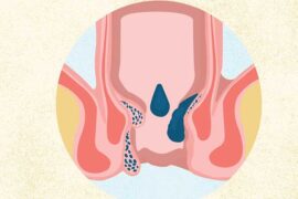 An Expert Says a 5-Minute Hack Can Reduce Hemorrhoid Flares