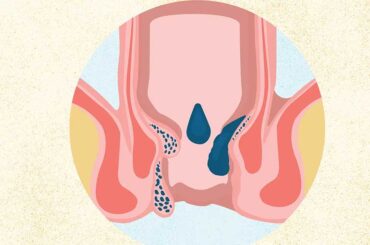 An Expert Says a 5-Minute Hack Can Reduce Hemorrhoid Flares