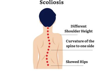 Scoliosis