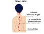 Scoliosis