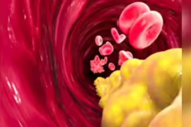 Five Silent Warning Signs of High Cholesterol in 30% of Indians