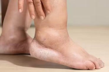 Ankle swelling