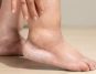 Ankle swelling