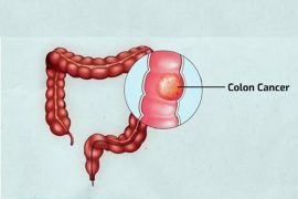 Colorectal Cancer