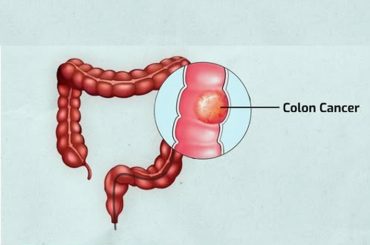 Colorectal Cancer