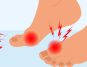 Night Foot Pain and Uric Acid