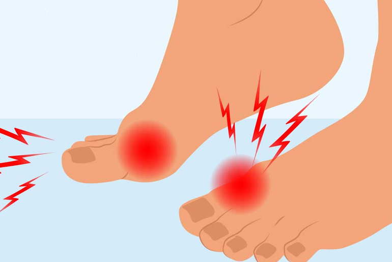 Night Foot Pain and Uric Acid