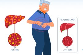 Liver Cancer Warning: How Diets Rich in Fat Can Make Healthy Liver Cells Dangerous