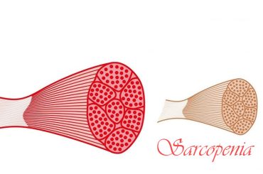 Sarcopenia